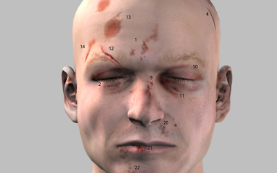 3D Injury Depiction